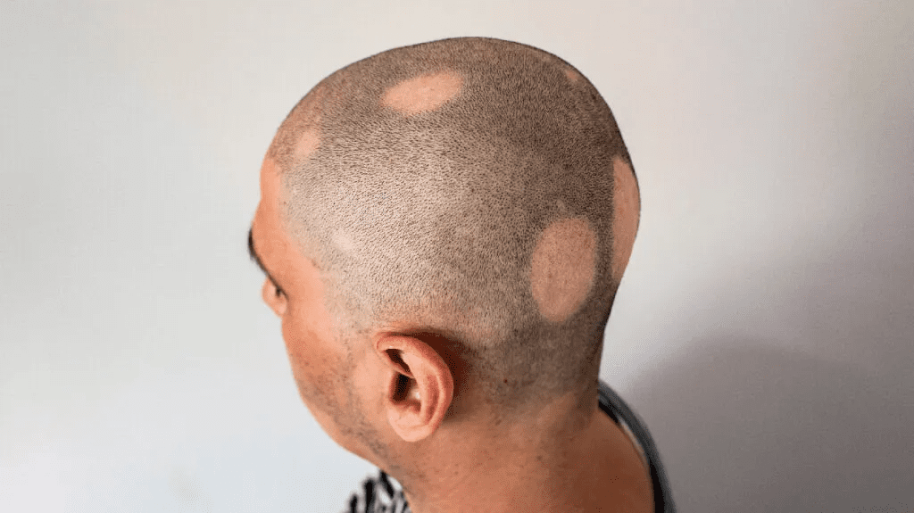 Photo showing a scalp with round, smooth patches of hair loss characteristic of alopecia areata.