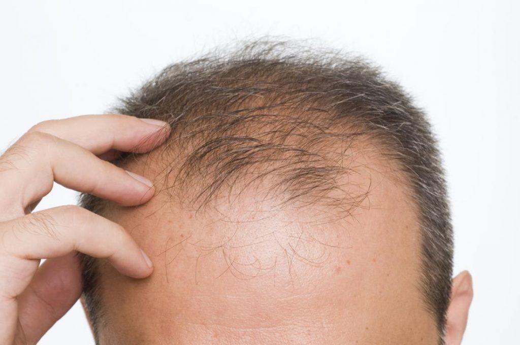 Close-up view of a person’s scalp showing signs of hair thinning.